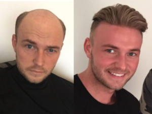 hair replacement service stamford The Hairline Inc.