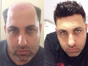 hair replacement service stamford The Hairline Inc.